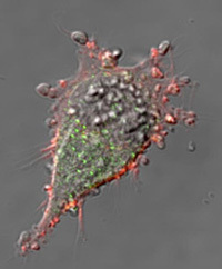Microvesicles stud the surface of a human invasive melanoma cell