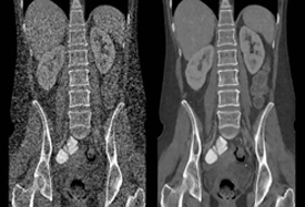 Filtered back projection (FBP) image reconstruction using conventional CT imaging (left) and an image reconstruction using Veo (right).